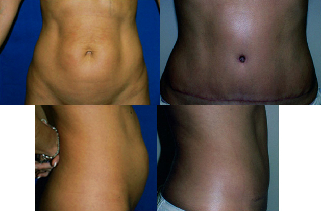 Tummy Tuck Before and After Pictures Case 570, Houston, TX